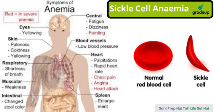 Know All About Sickle Cell Anemia